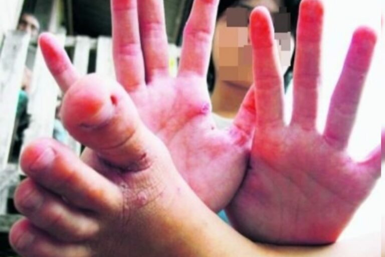 KKM tidak galak guna serbuk kunyit, daun semambu untuk rawat HFMD