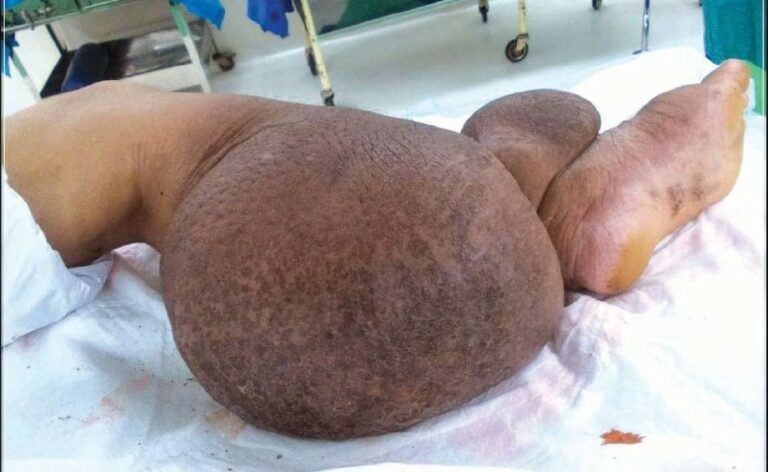 Kampungku di ‘serang’ penyakit untut (kaki gajah)
